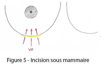 figure 5 incision sous mammaire