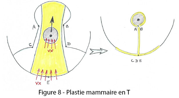 figure 8 : plastie mammaire en T