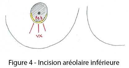 figure 4 incision aréolaire inférieure